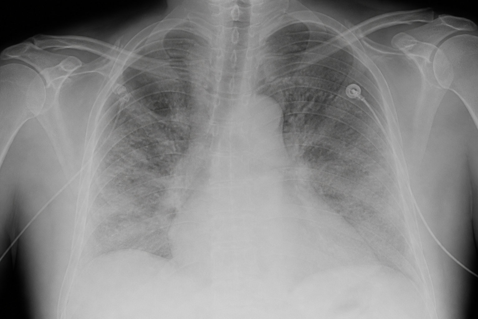Examens cliniques et rôle des biomarqueurs cardiaques