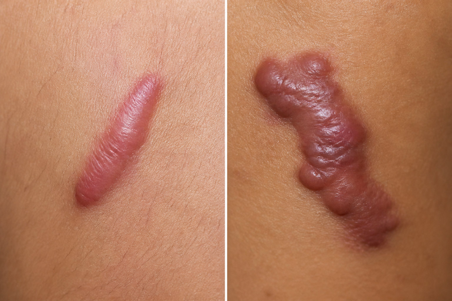 Pansement silicone : quelles cicatrices traiter en priorité ?